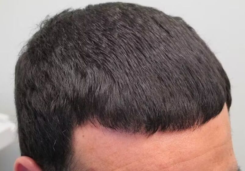 Saç dökülmesini iyileştirdim Verdoxidil