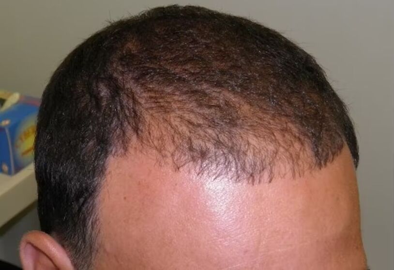 Verdoxidil kullanmadan önce saç dökülmesi